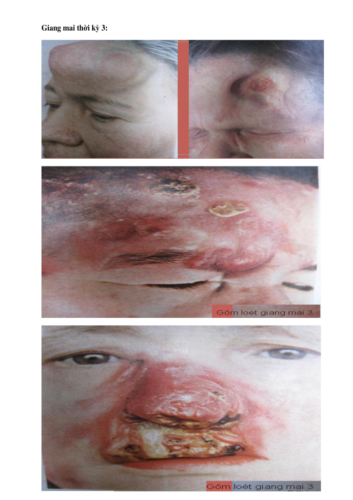 Giang mai: 4 giai đoạn, triệu chứng và xét nghiệm theo thời gian – TOP ONE HIV
