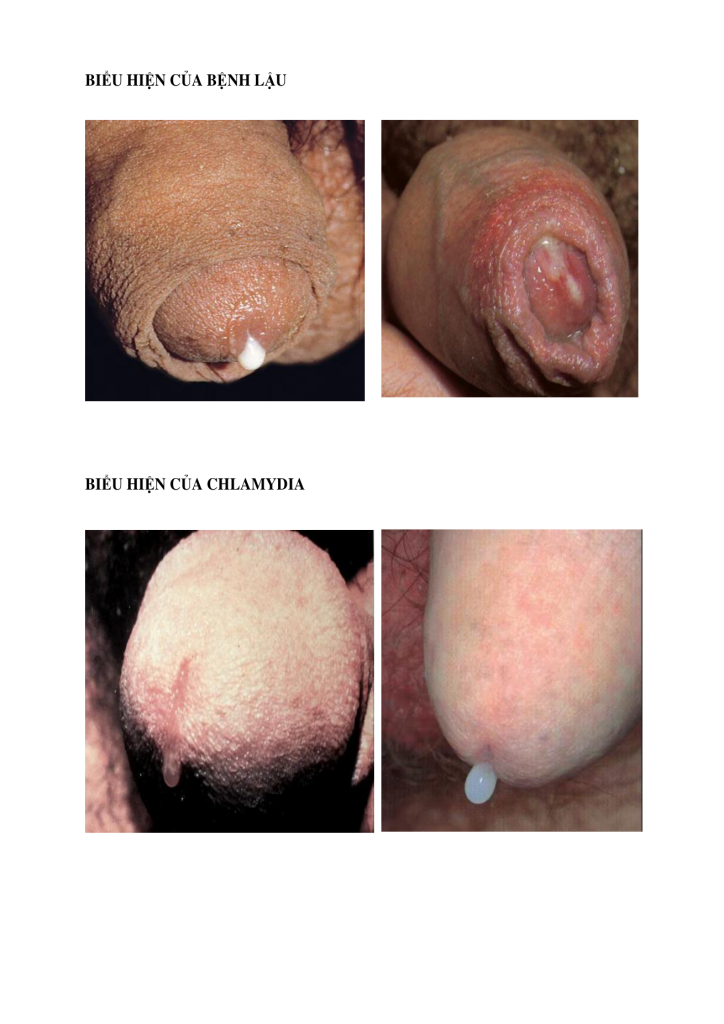 Lậu và Chlamydia ở họng, trực tràng: vì sao dễ bị bỏ sót? – TOP ONE HIV