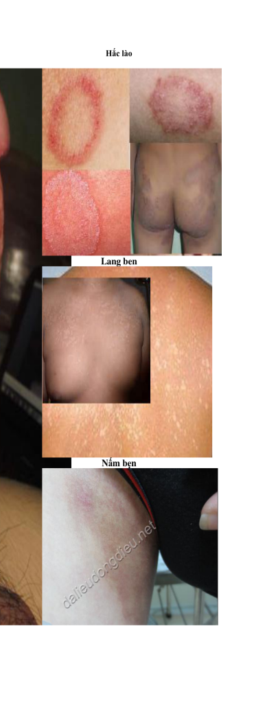 Nấm da, hắc lào và tổn thương vùng kín: nhận biết và khi nào cần khám? – TOP ONE HIV