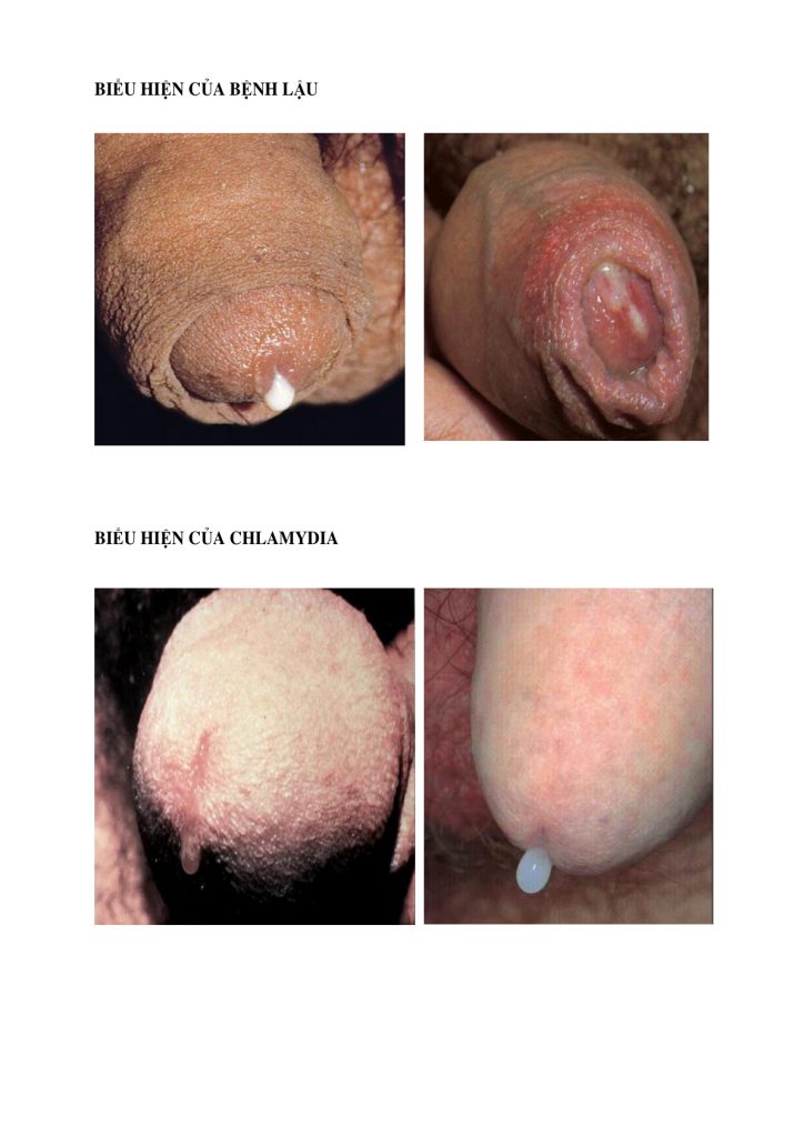 Hình minh họa biểu hiện bệnh lậu và Chlamydia – trích trang 6 tài liệu người dùng cung cấp.