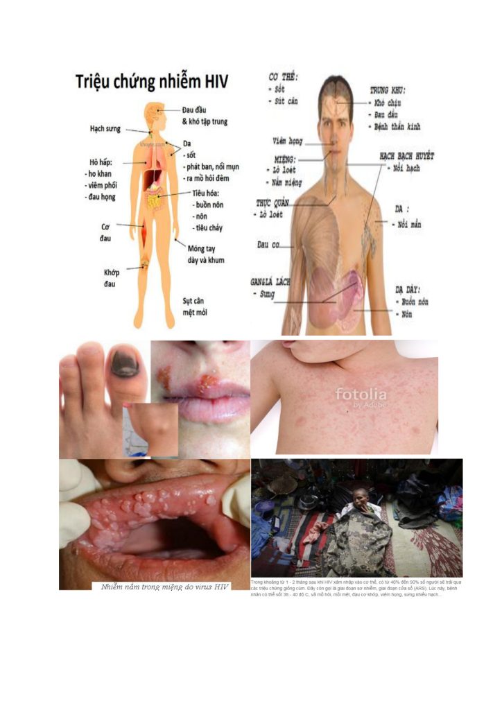 Hình minh họa các biểu hiện có thể gặp khi nhiễm HIV – trích trang 1 tài liệu người dùng cung cấp.