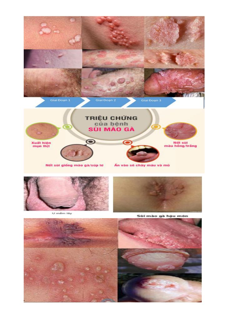 Hình minh họa các dạng tổn thương sùi mào gà/HPV – trích trang 2 tài liệu người dùng cung cấp.
