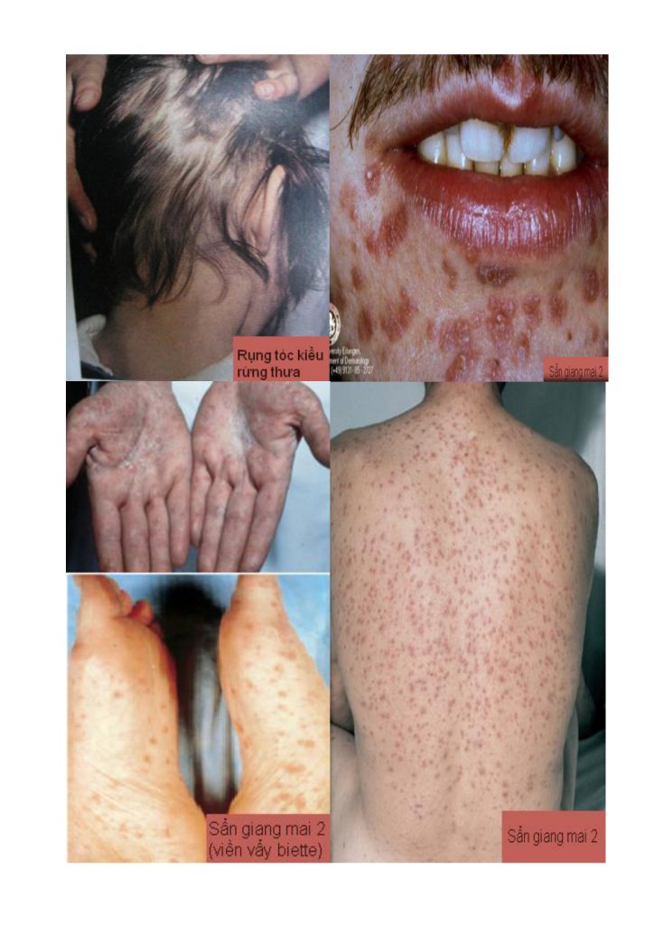 Hình minh họa các biểu hiện giang mai giai đoạn 2 – trích trang 4 tài liệu người dùng cung cấp.